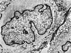 F, 49y. | myelosarcoma … histiocyte-like cells in dermal infiltrates F, 49y. | myelosarcoma … histiocyte-like cells in dermal infiltrates